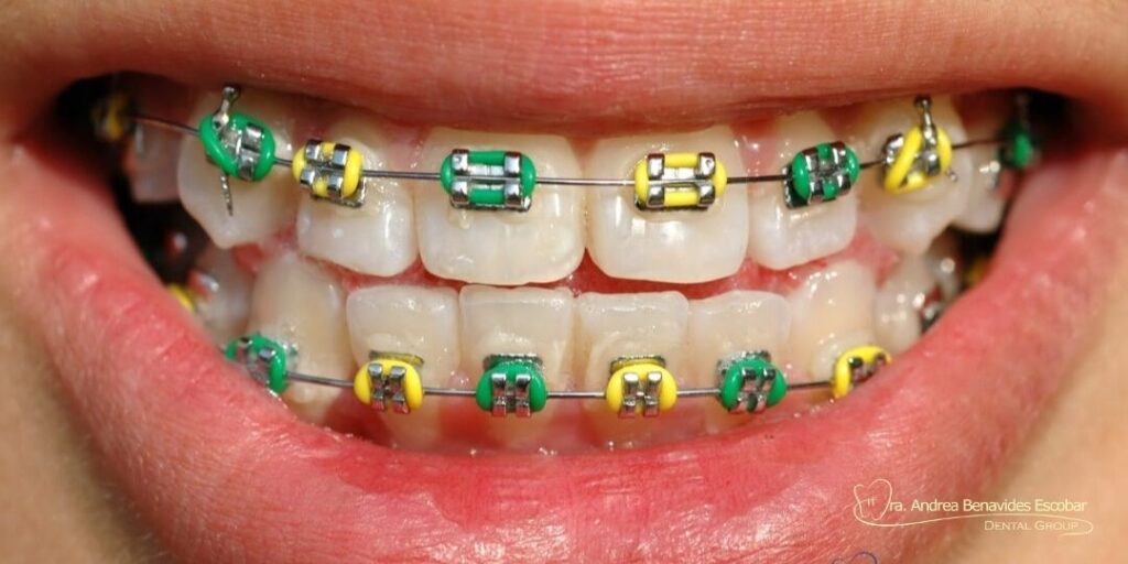 Guía Definitiva 2026: Cómo Elegir los Mejores Colores para mis Brackets y Resaltar mi Sonrisa