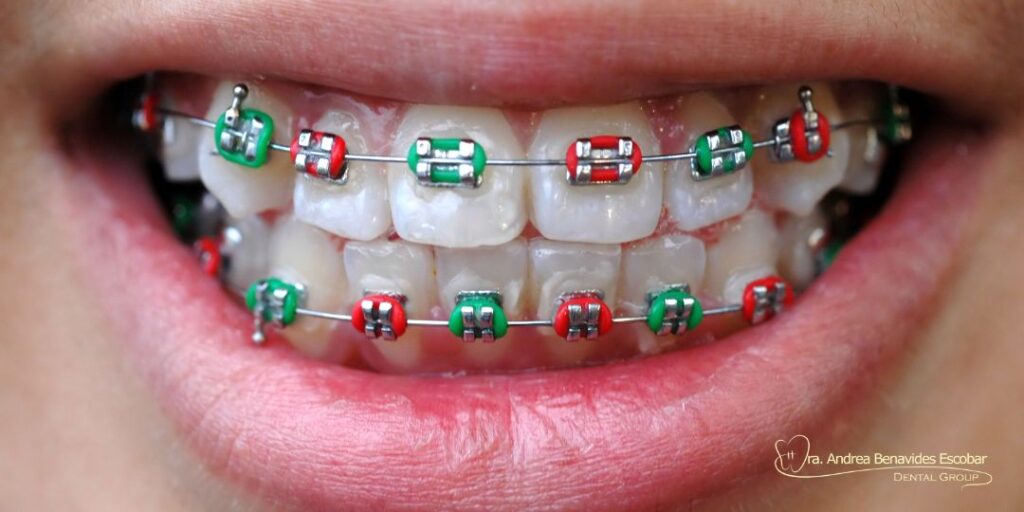 color para mis brackets