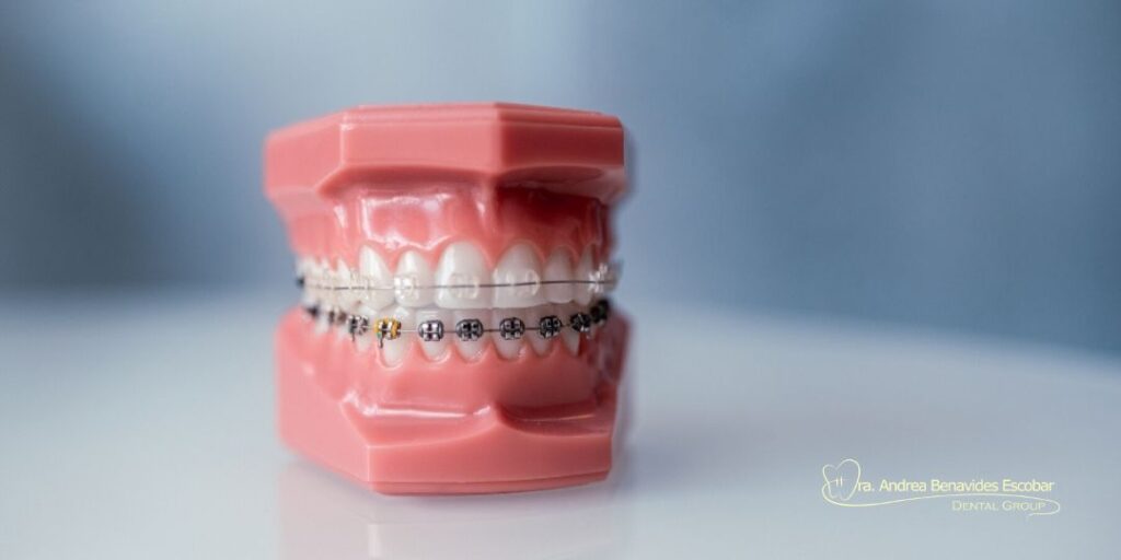 Ortodoncia con brackets estéticos o metálicos