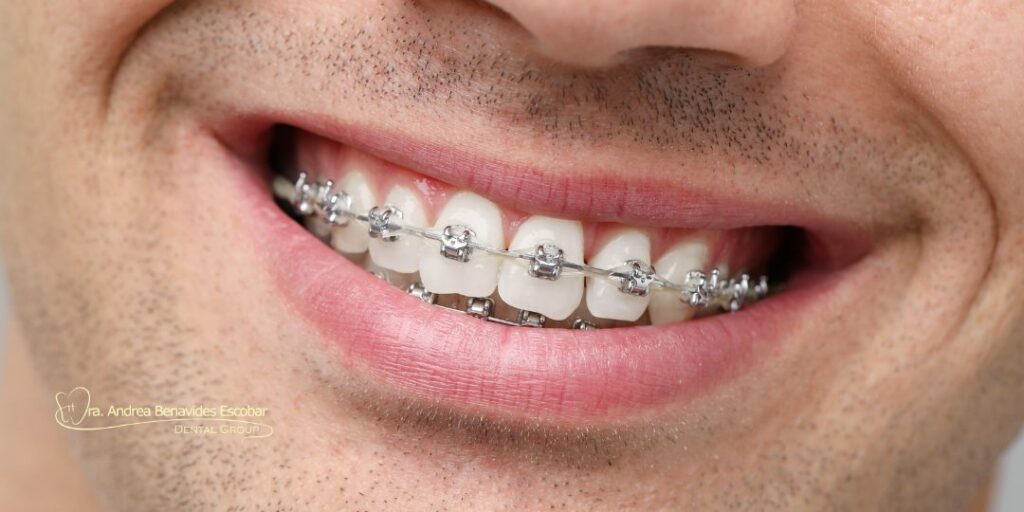 Beneficios de mantener una adecuada higiene oral durante la ortodoncia