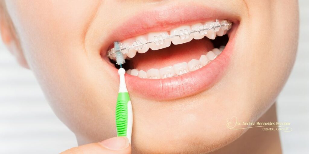 Recomendaciones para cuidar tus dientes durante el tratamiento de ortodoncia
