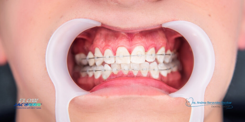 ¿Cómo funcionan realmente la ortodoncia con mini tubos en Armenia para alinear tu sonrisa de forma más eficiente?