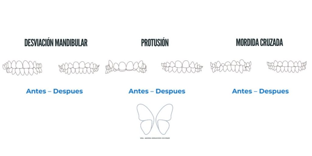 ¿Qué es el sistema ortodoncia invisible Smartee GS y cómo logra el avance mandibular sin cirugia?