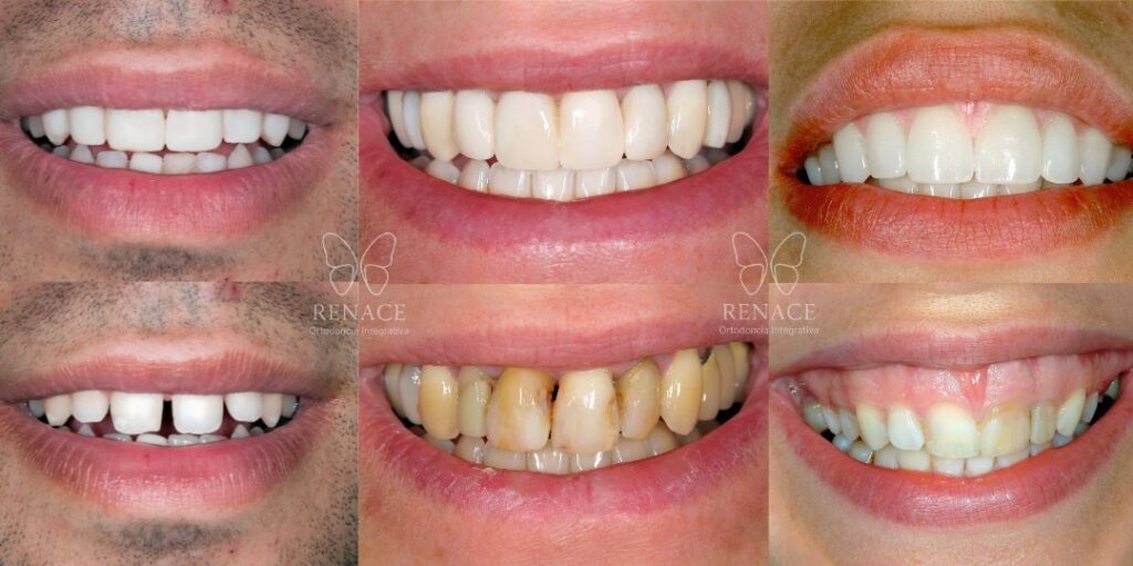 ortodoncia con diseño de sonrisa: El camuflaje vs. La estructura, ¿Por qué tus carillas se rompen?