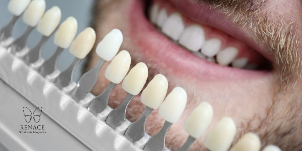 Para tener ortodoncia con diseño de sonrisa, es indispensable saber de qué material son tus carillas