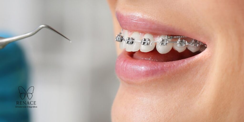 ¿Cuál es la diferencia entre brackets metálicos y de zafiro?