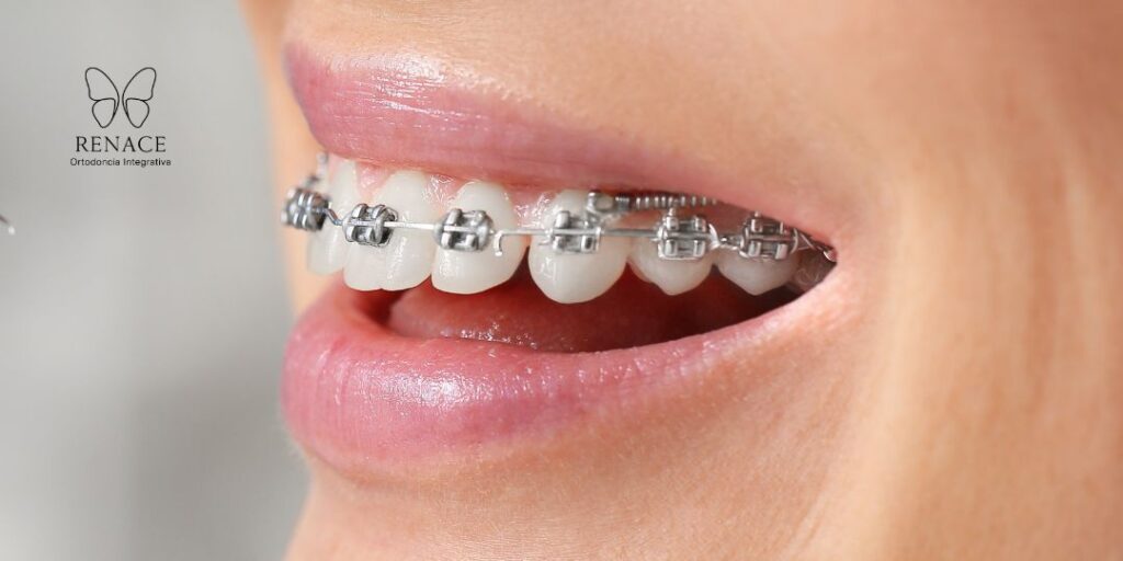 ¿Cómo lavarse los dientes con brackets paso a paso?. La importancia de una higiene impecable durante el tratamiento