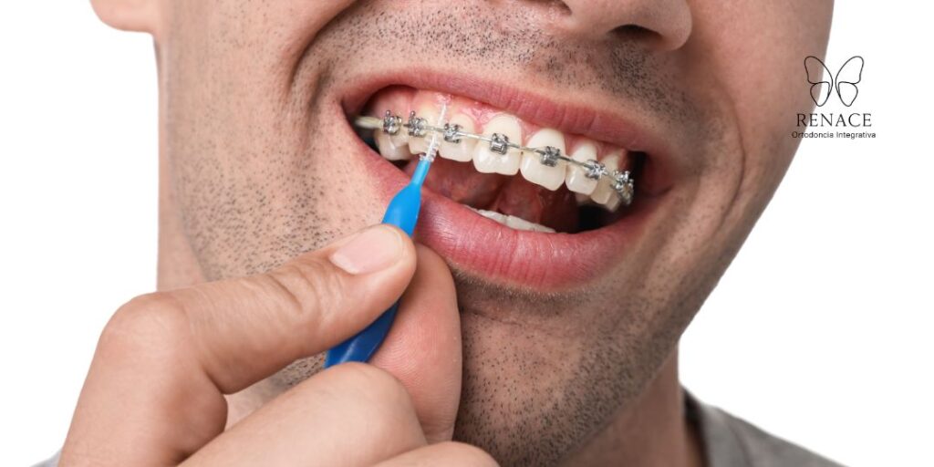 El paso a paso: ¿Cómo lavarse los dientes con brackets?