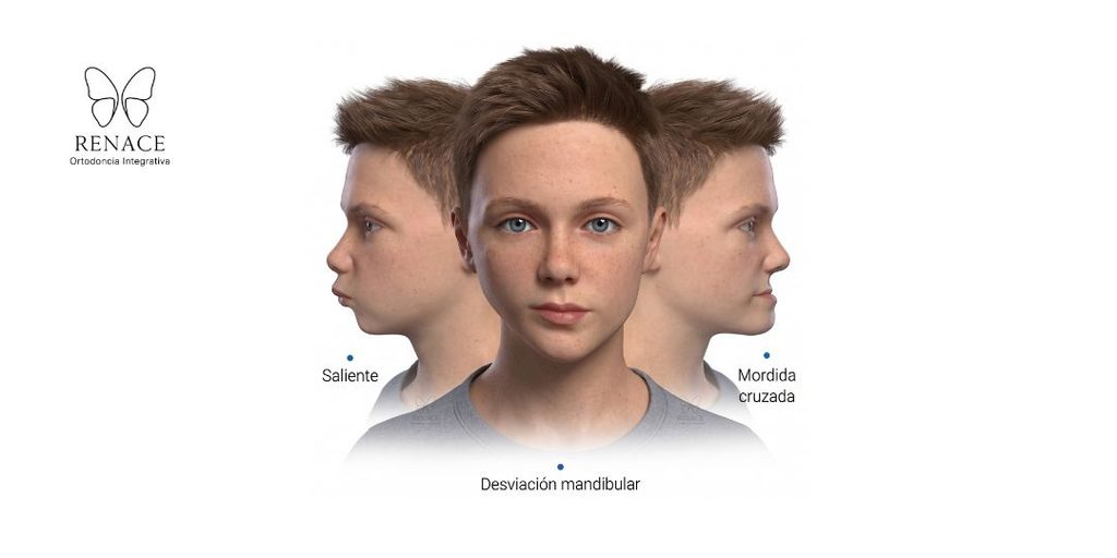 ¿Qué es la reposición mandibular en niños y cuándo se realiza?